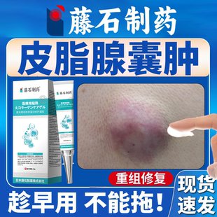 粉瘤皮脂腺囊肿专用膏药贴拔毒膏皮下鼓包硬肿块疖肿火疖子凝胶OZ