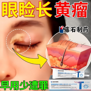 眼睑睑黄瘤去除神器专用睑黄疣眼角去眼皮黄斑瘤药房同款膏眼部DZ