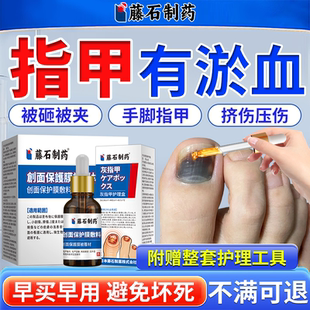 指甲淤血脚指甲砸伤甲下手脚趾指甲被夹被砸压伤指甲盖瘀血出血OZ