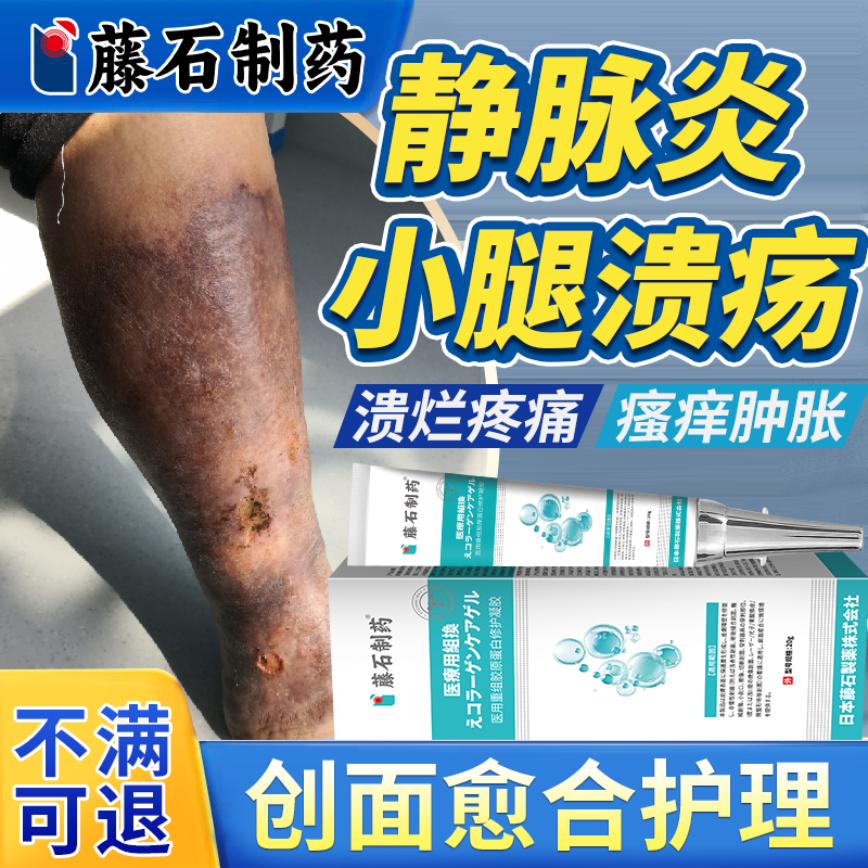 静脉炎血栓静脉曲张小腿溃疡肿痛专用老烂腿贴药房同款膏弹力袜EM