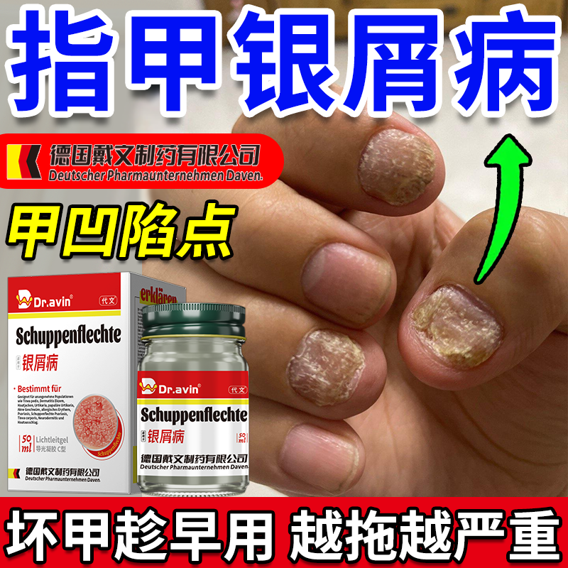 【德国监制】专研指甲银屑病
