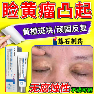眼部眼睑黄疣睑黄瘤去除神器去眼皮黄斑瘤搭专用日本薬房同款膏DZ