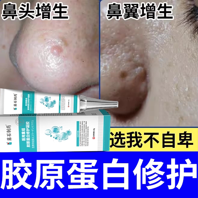 鼻部皮脂腺增生增大面部粟丘疹鼻头鼻翼去鼻子上小肉疙瘩起丘疹BS