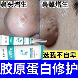 鼻部皮脂腺增生增大面部粟丘疹鼻头鼻翼去鼻子上小肉疙瘩起丘疹BS