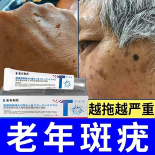 老年斑疣脸上手背扁平疣去除膏一抹灵软膏专用去增厚凸起 黑斑DZ