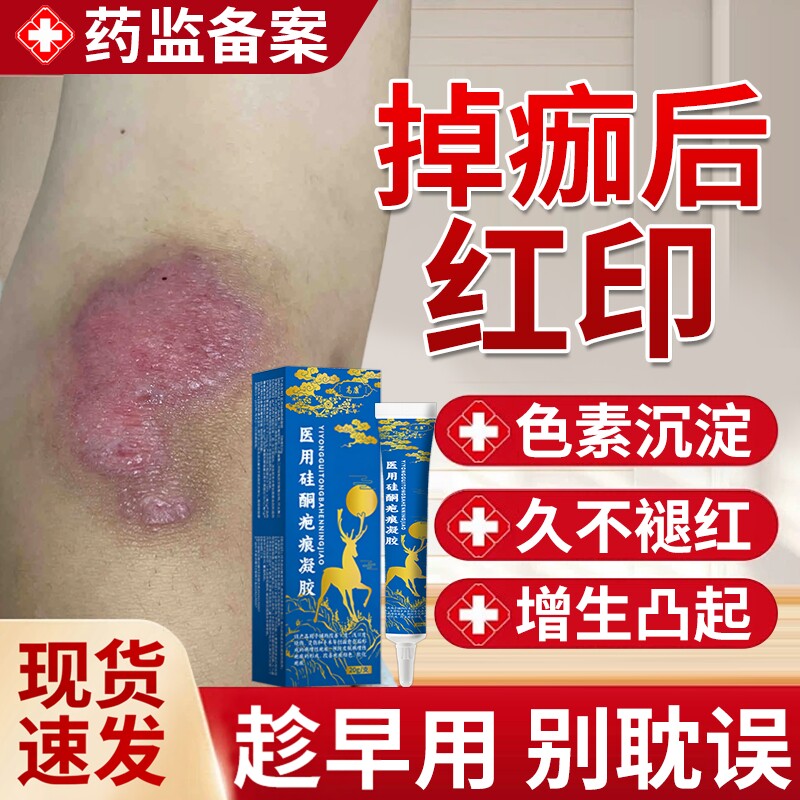 【医用硅酮】淡化红印黑印祛疤膏图片
