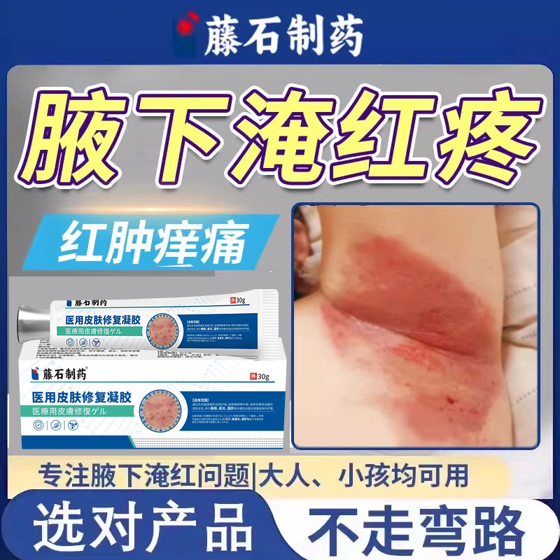 腋下淹红腋窝胳肢窝淹了成人痱可搭子粉湿防脖子疹红痒肿疼出汗OZ