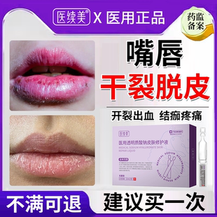 唇炎唇膏嘴唇干裂脱皮医用型嘴角干燥起皮专用口周皮炎药房同款EM