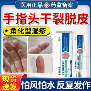 角化型手部湿疹角质化手指脱皮干裂皲裂真菌感染手癣膏药房同款JW