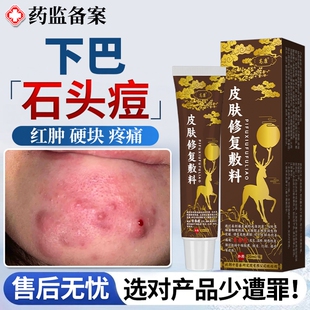 下巴反复长痘祛石头痘淋巴腮边红肿结节硬块痘痘痤疮膏药房同款JW