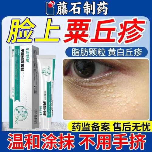 脸上小疙瘩眼周粟丘疹油脂颗粒