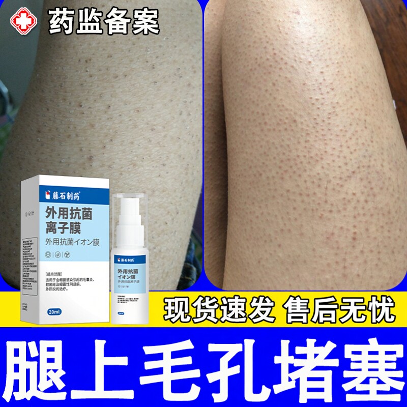 腿上毛囊炎腿部毛孔堵塞疏通毛囊鸡皮肤毛周角化症药房同款膏JW