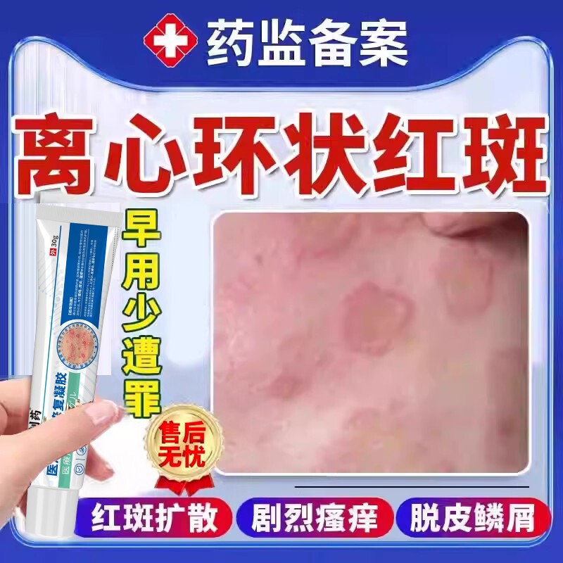 离心性环形状红斑湿疹荨麻疹过敏止痒断铜钱癣体癣根药监备案膏BS