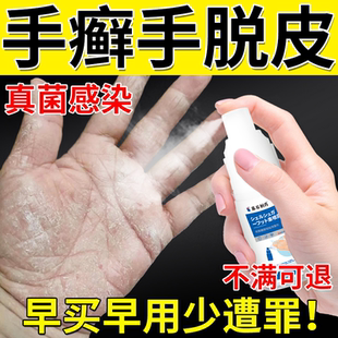 手癣膏脱皮干裂开裂真菌感染鹅掌风手藓手气痒药房同款专用喷剂JW