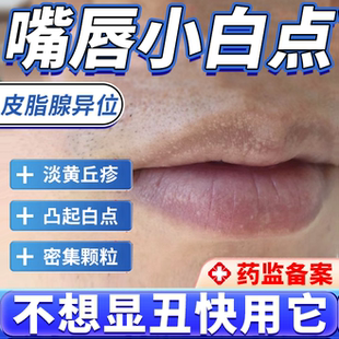 皮脂腺异位症嘴唇白点脂肪小颗粒增生嘴皮干燥起皮药房同款膏JW