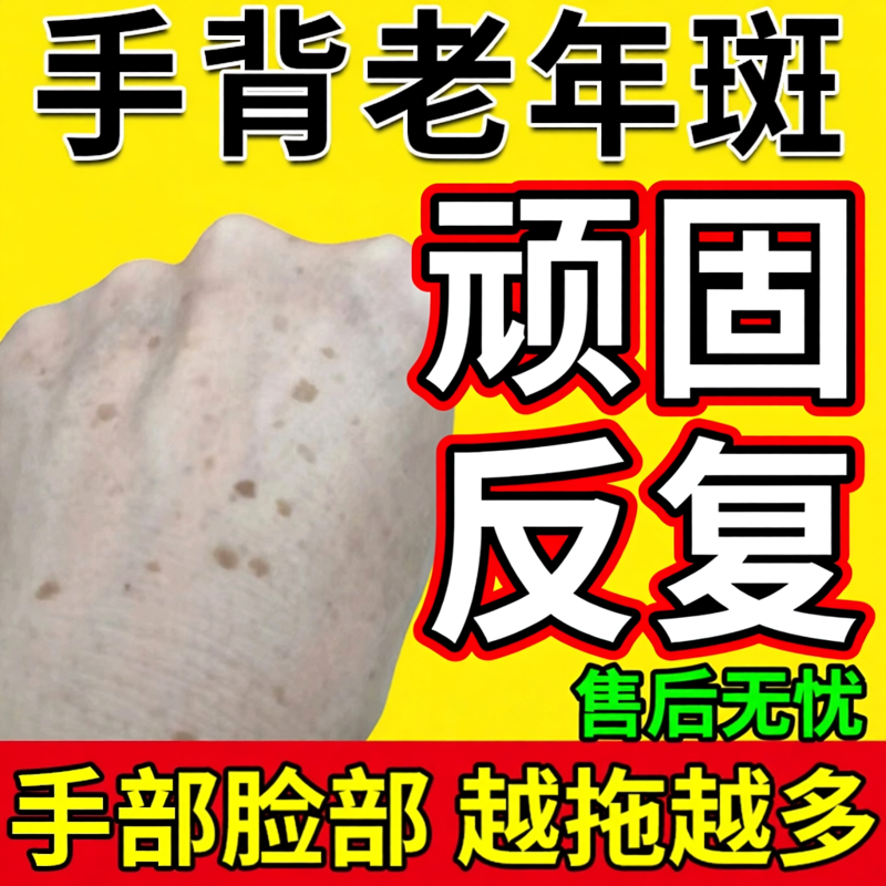 藤石制薬手背手上的老年斑专用强力扁平疣去除手部一抹脸部净膏MP