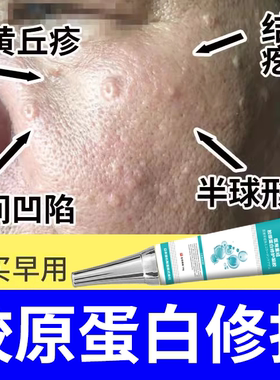 皮脂腺增生增大面部胸前囊肿黄色丘疹早熟性老年性脸上起小疙瘩DZ