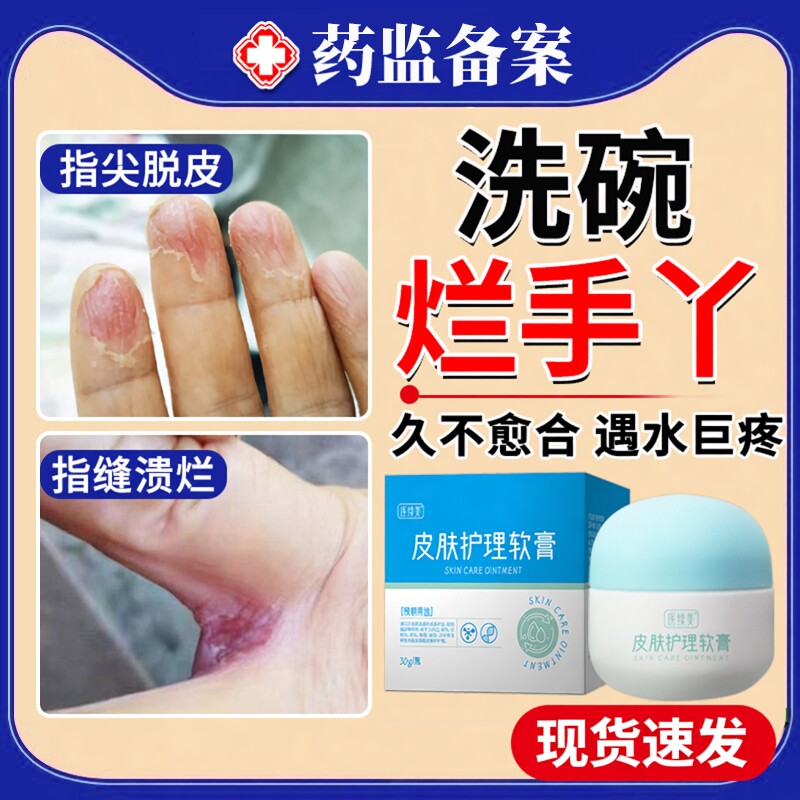 洗碗烂手丫软膏专用手指缝烂痒水泡长期泡水溃烂专治药房同款膏JW