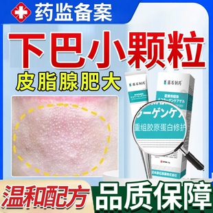 下巴小疙瘩颗粒皮脂腺异位症增生肥大白点长痘闭口脂肪粒粟丘疹OZ