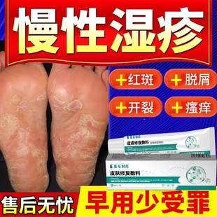 慢性湿疹止痒去外用顽固皮炎脚底脚部湿诊根脚气脚癣真菌感染痒DZ