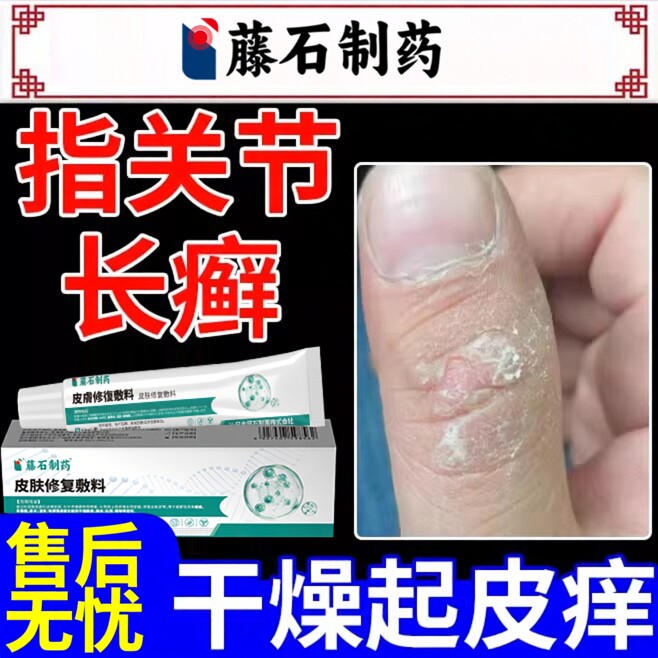手指关节癣手癣膏脱皮干裂真菌感染长藓硬疙瘩干裂脱皮痒鹅掌风DZ
