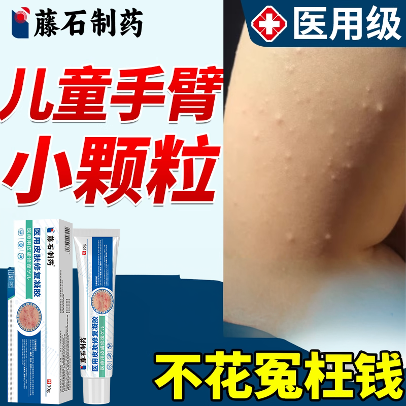 儿童手臂上小疙瘩颗粒胳膊的毛囊炎专用毛周角化症鸡皮脂肪粒去EM