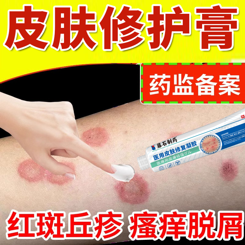 铜钱癣体癣金钱藓专用顽固性皮癣湿疹皮肤瘙痒可搭止痒中材用OZ
