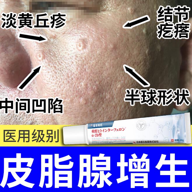 皮脂腺增生增大面部胸前囊肿黄色丘疹早熟性老年性脸上起小疙瘩yr