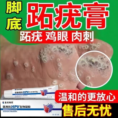 【医用级】脚底长跖疣石疣专用膏
