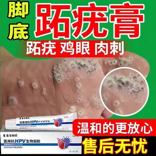【医用级】脚底长跖疣石疣专用膏