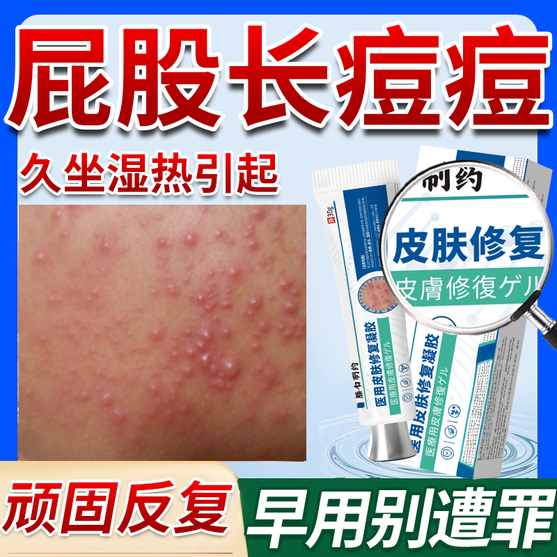 屁股上长痘痘痒起热疙瘩药湿毒清软膏湿疹慢性股藓止痒久坐板疮OZ