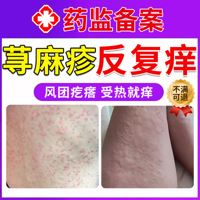 现货速发荨麻疹过敏反复痒就用它