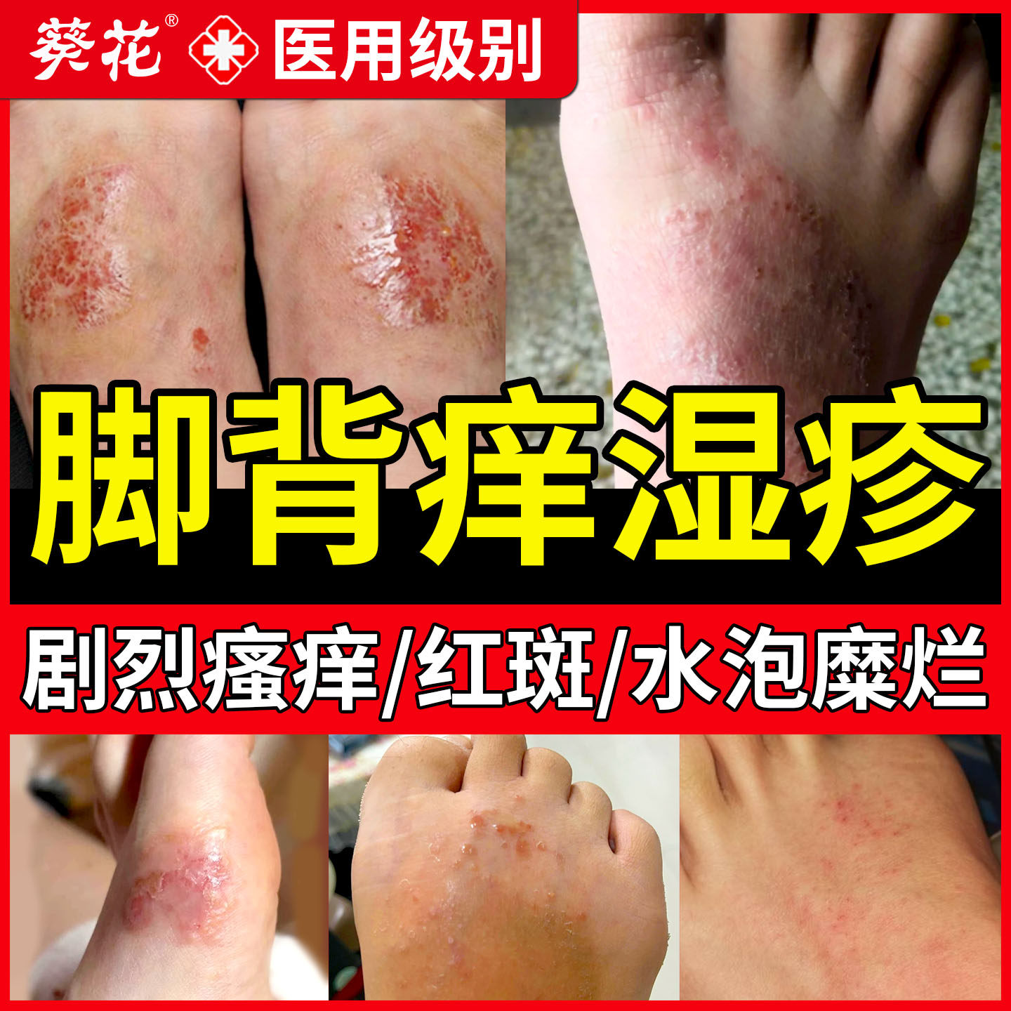 脚背瘙痒湿疹脚上水泡去止痒根红斑脚癣脱皮脚面发痒药房同款膏TU