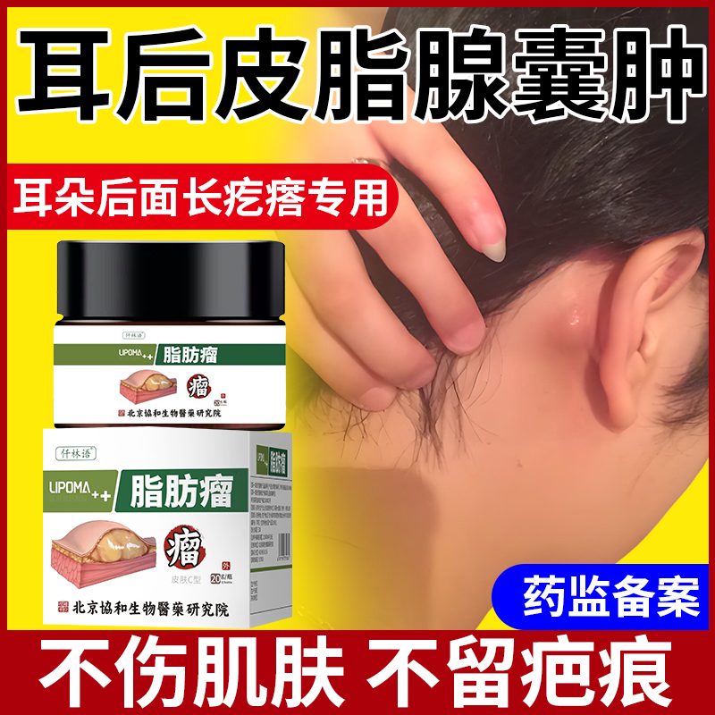 耳后皮脂腺囊肿膏粉瘤去皮下火疖子鼓包疖肿拔毒膏脂肪瘤拔脓包pe