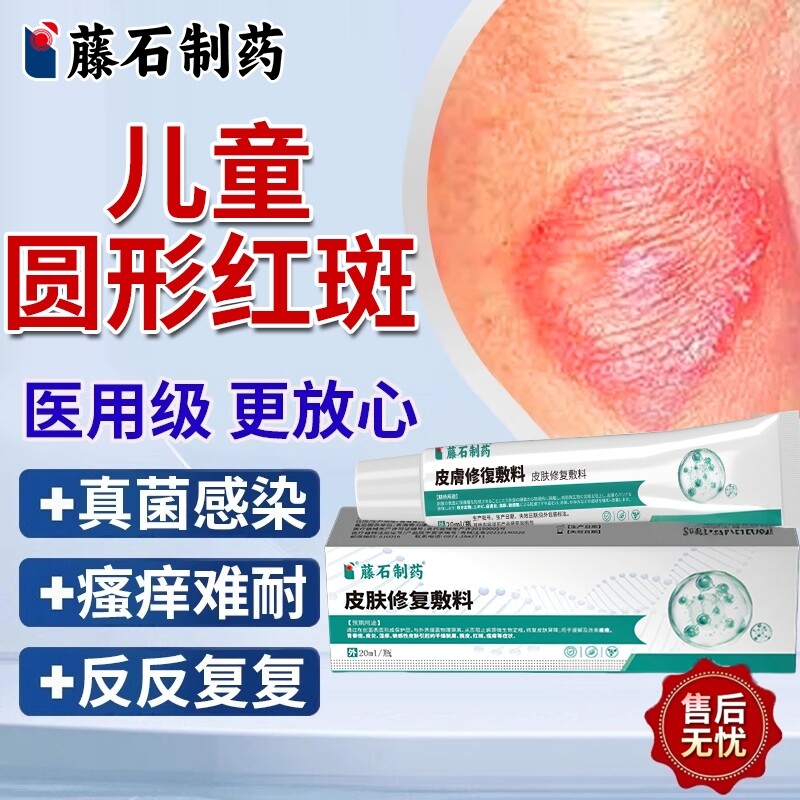 儿童铜钱癣藓体癣真菌感染专用皮肤瘙痒红斑去癣外用药房同款膏YS