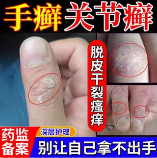 手指关节癣手癣膏脱皮干裂真菌感染鹅掌风手藓湿疹止痒足YY