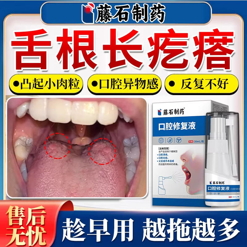 舌根长疙瘩舌头起淋巴滤泡增生起泡囊肿慢性咽炎咽喉炎异物感YY