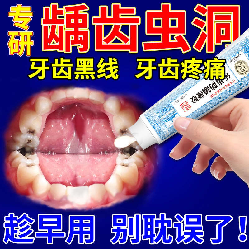 防蛀固齿抗敏含氟成人蛀牙专用虫牙药监备案可搭牙膏儿童补牙缝Y8