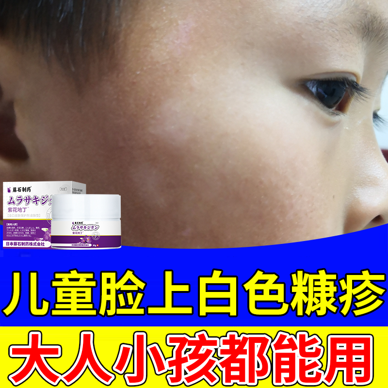 儿童脸上白色糠疹膏长白斑小孩长癣汗斑桃花癣可搭配瘙痒药膏用pe