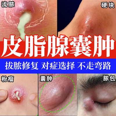 藤石制药皮肤修复敷料皮脂腺囊肿