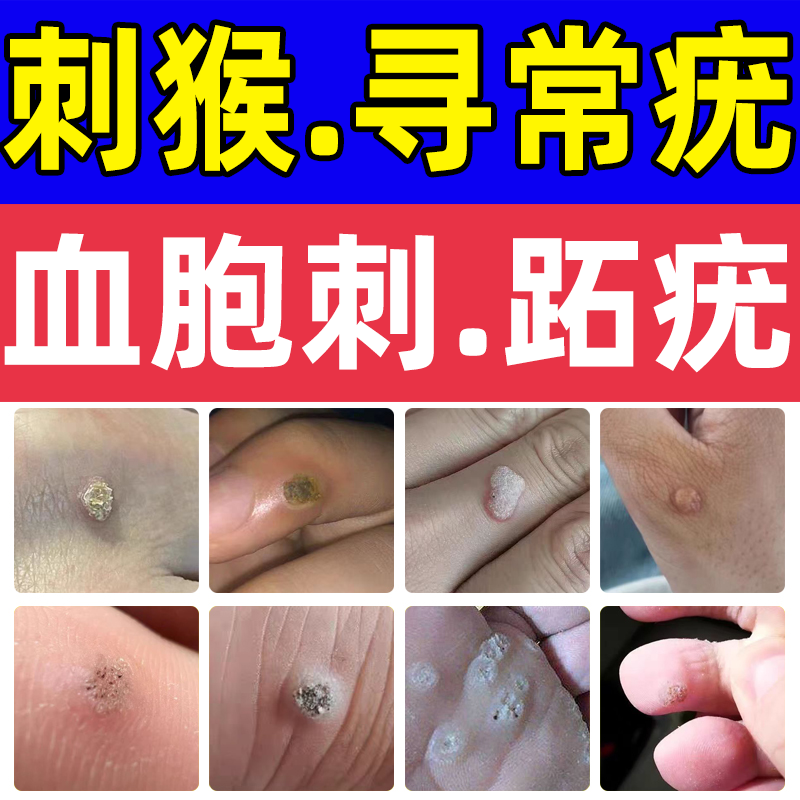 寻常疣去除手足跖疣趾疣肉刺刺猴