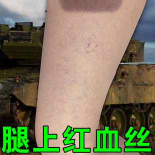 腿上红血丝毛细血管扩张引起红血丝久站引起腿上红血丝