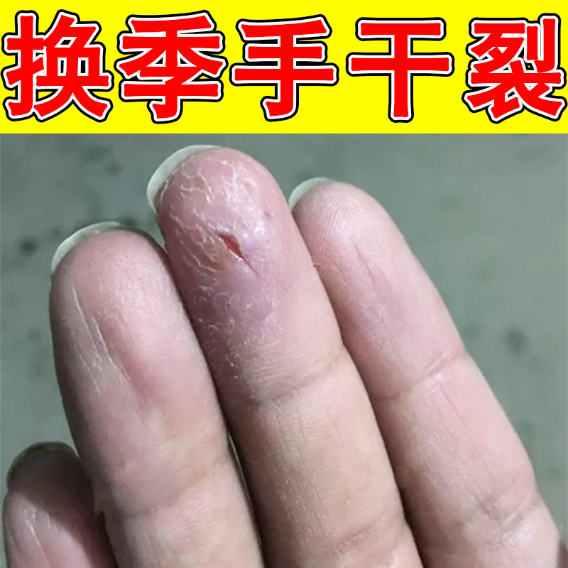 秋冬换季手指头干裂起皮掉屑手粗糙干燥去死皮硬皮真菌手脚裂口子