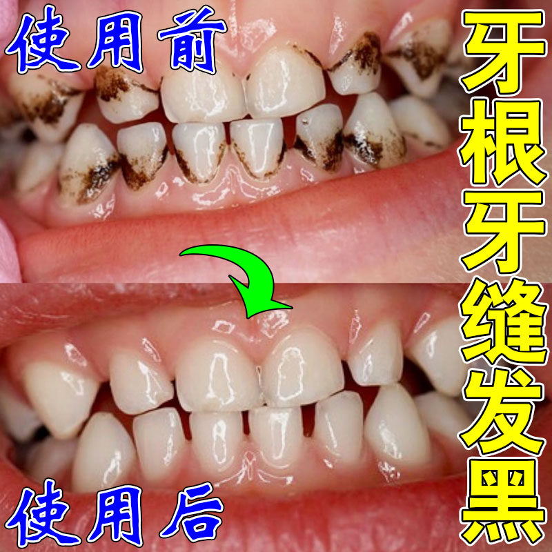 牙根牙缝发黑牙齿黑斑黄牙齿牙垢烟渍茶渍清理牙斑净