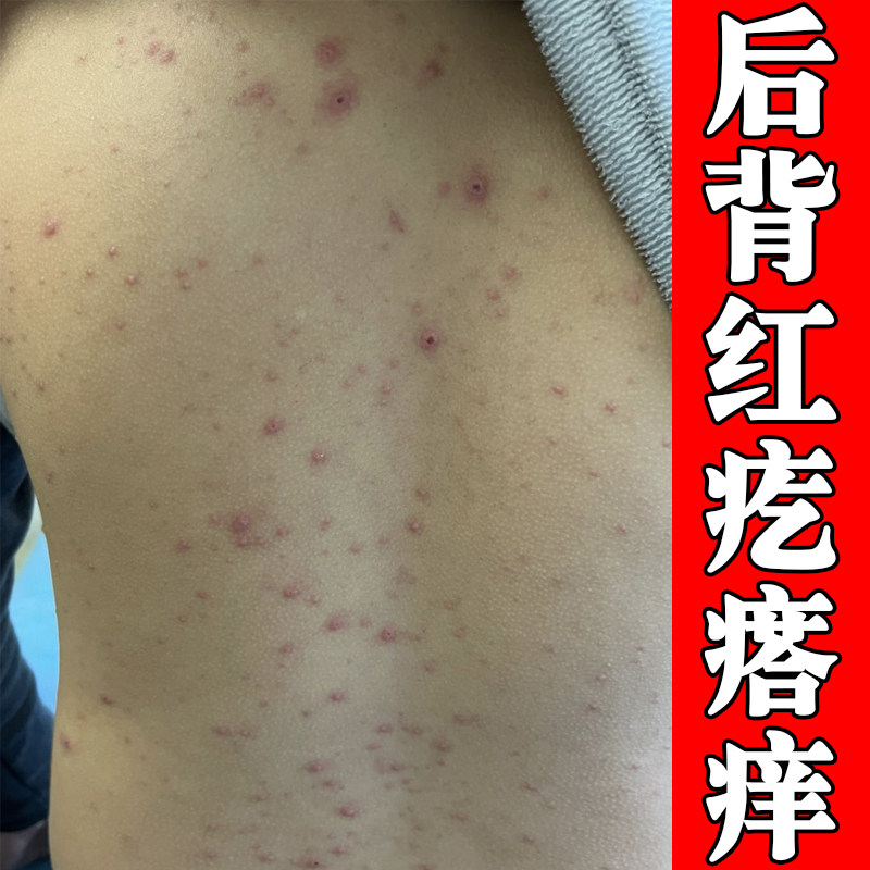 后背红疙瘩痒真菌前胸后背长痘痘密密麻麻小红点痒身上皮肤修复药