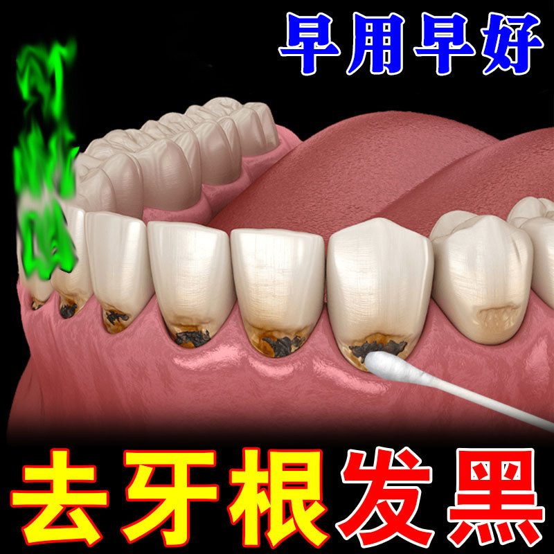 牙根发黑去除牙垢牙菌斑牙烟渍牙斑净去牙缝发黑清理神器氟斑牙药