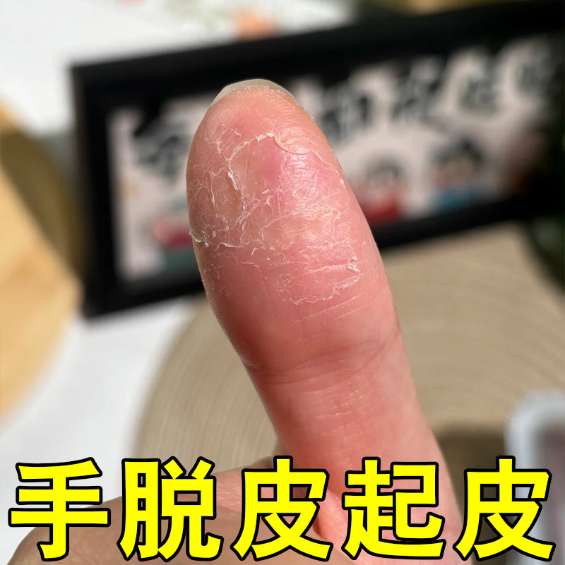 手指头起皮掉屑去死皮起硬皮手干裂真菌手脚严重干燥粗糙蜕皮药