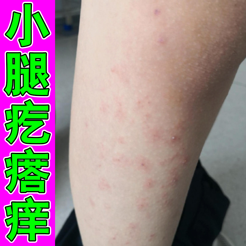 身上痒起红疙瘩痘痘丘风团性皮肤干燥粗糙过敏痒小腿手臂痒疙瘩药