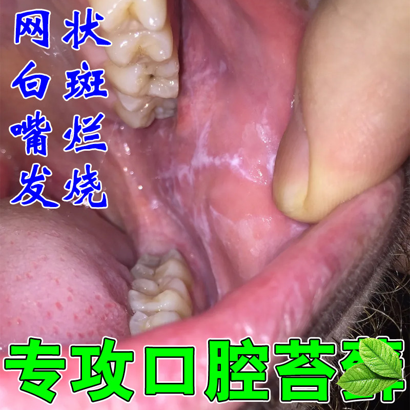 口腔扁平苔专用修复口腔网状白斑糜烂溃疡口腔粘膜纤维化药