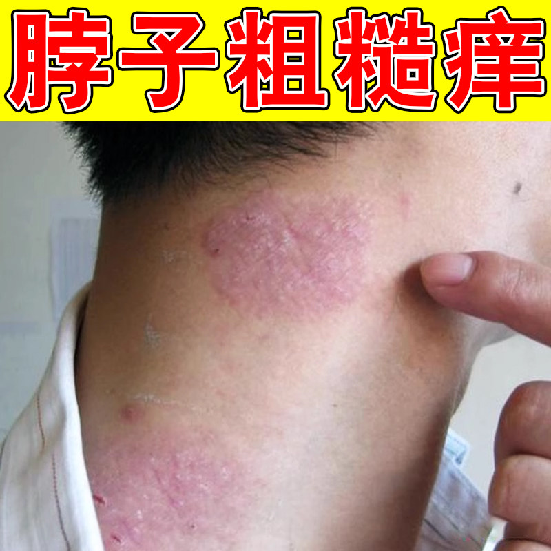 脖子上痒神经性痒出汗刺挠脖子后面痒长小疙瘩起皮掉屑痒外用软膏